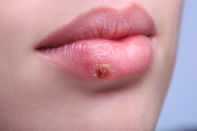 Foto de Remédio manipulado para herpes: principais dúvidas sobre o assunto