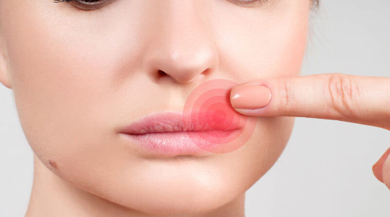 Foto de Sofre com herpes? Conheça os benefícios do fanciclovir