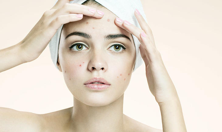 Foto de Fórmulas manipuladas para acne - top 5 fórmulas para tratar acnes