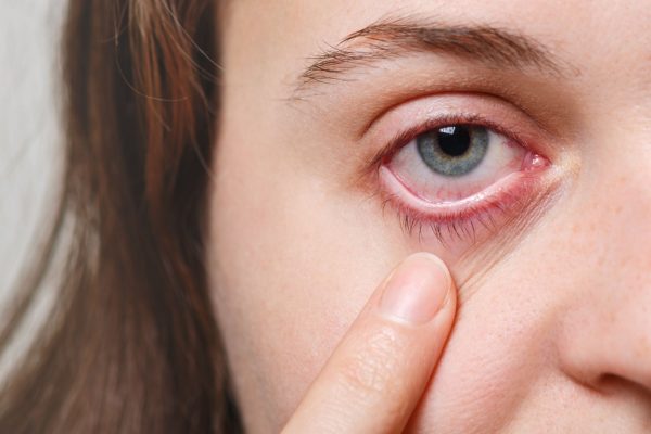 Foto de O que está por trás da ardência nos olhos