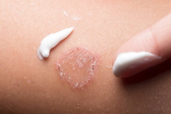 Foto de Como usar o nitrato de miconazol?
