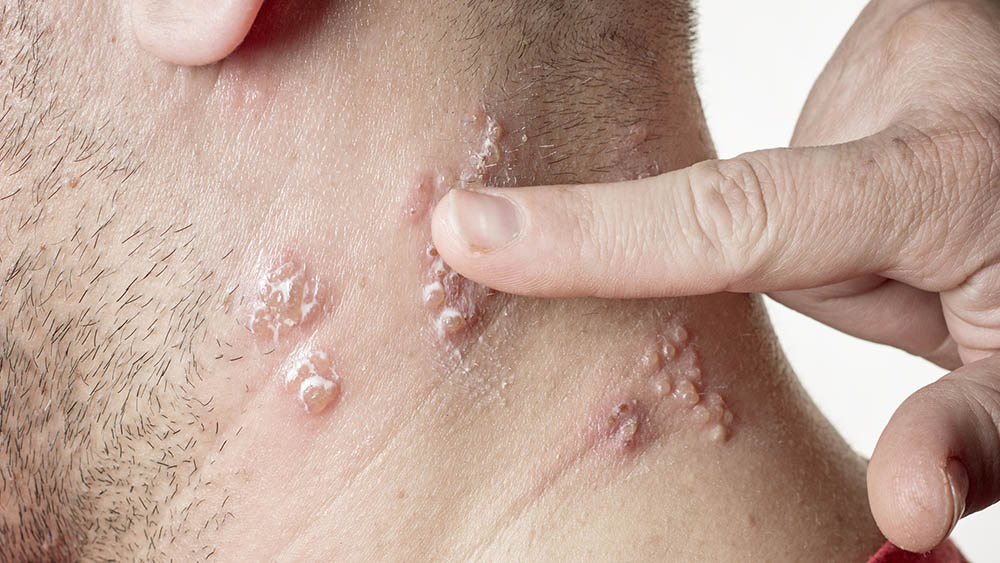 Foto de Sofrendo com herpes? Aciclovir pode ser a solução dos seus problemas
