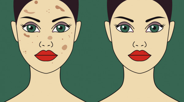 Foto de Melasma: o que é, principais causas e como tratar melasma